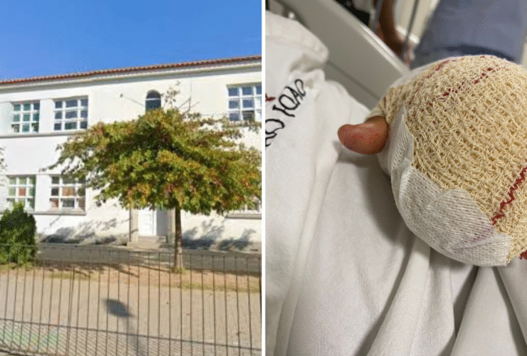 Montagem com duas imagens. À esquerda, a fachada da Escola Básica de Fonte Coberta, em Portugal, com prédio branco, janelas e uma árvore em frente. À direita, a mão de uma criança com curativo espesso após amputação parcial de dois dedos, vista sobre um lençol hospitalar.