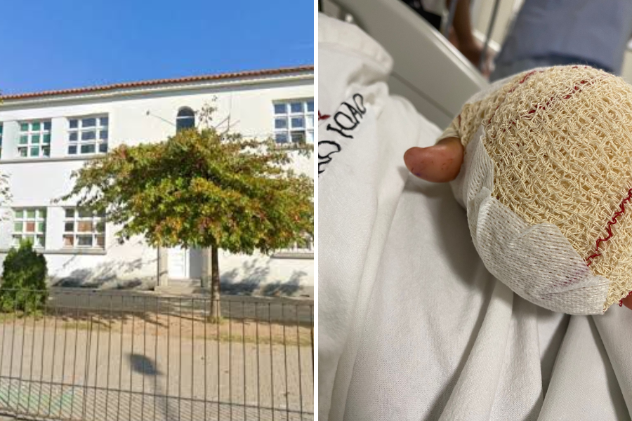 Montagem com duas imagens. À esquerda, a fachada da Escola Básica de Fonte Coberta, em Portugal, com prédio branco, janelas e uma árvore em frente. À direita, a mão de uma criança com curativo espesso após amputação parcial de dois dedos, vista sobre um lençol hospitalar.
