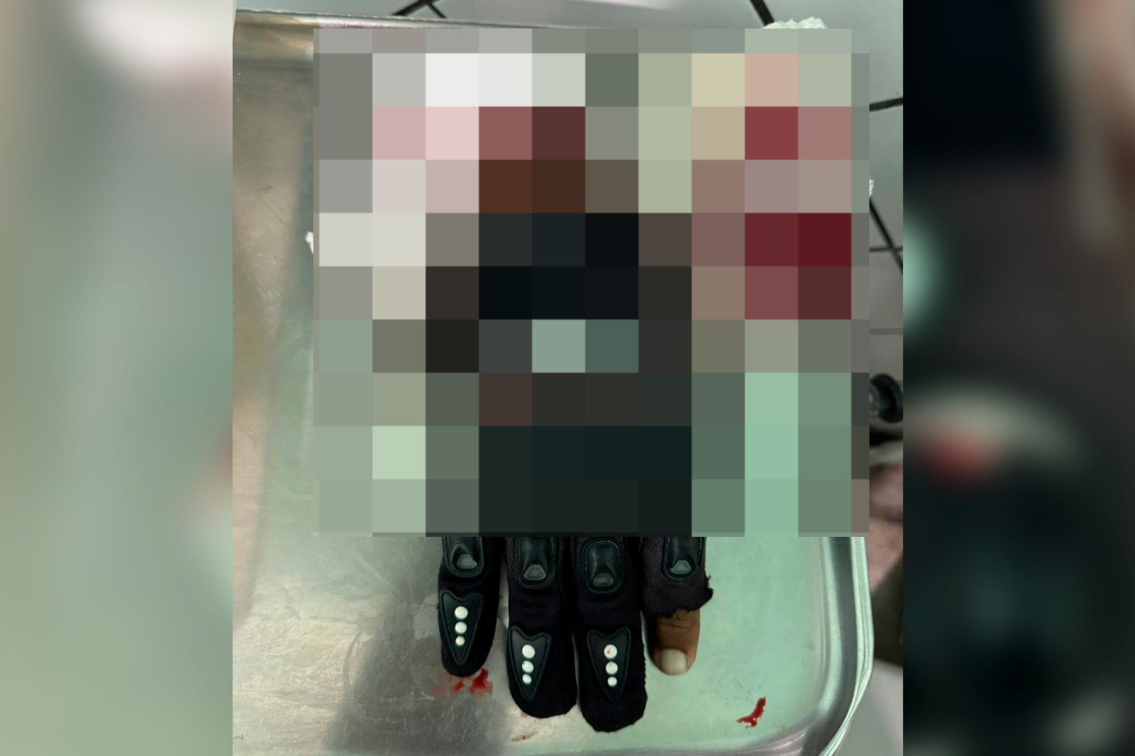 Mão de homem amputada após desentendimento