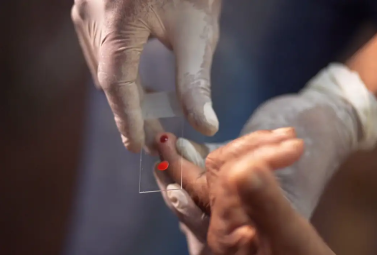 duas mãos, realizando coleta de sangue para exame de malária